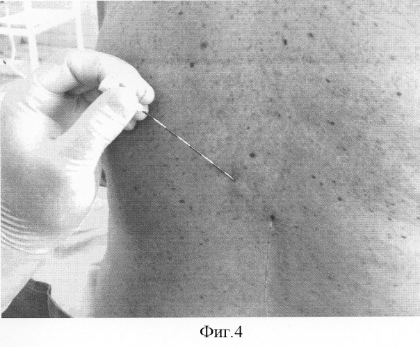 Безопасный способ постановки эпидурального катетера в &quot;туннеле&quot; для продленной аналгезии (патент 2301083)