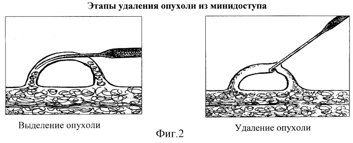 Способ удаления сухожильного ганглия, гигромы, небольшой эпидермальной кисты из мини-доступа с использованием крючка (патент 2315566)