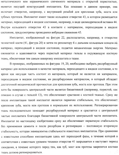 Имплантаты для создания соединений с тканями, в частности со скелетом, а также устройство и способ имплантации (патент 2314768)