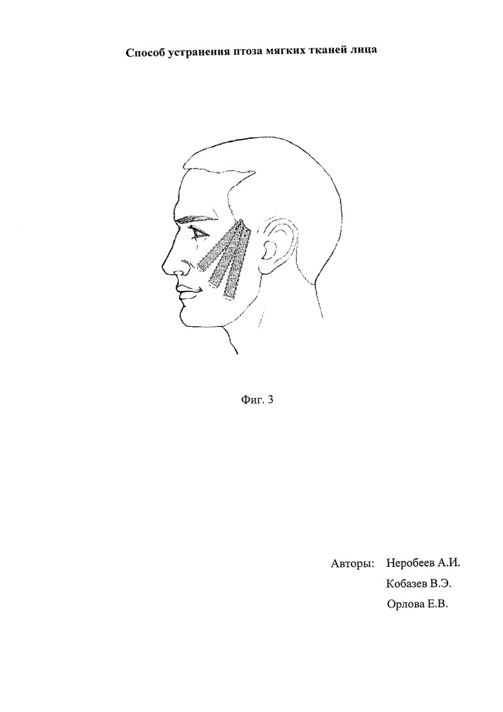 Способ устранения птоза мягких тканей лица (патент 2649965)