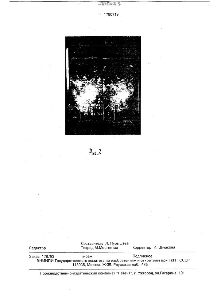 Способ диагностики угрожающего состояния беременности (патент 1780719)