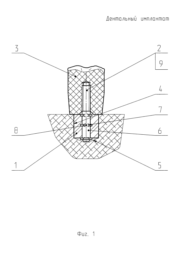 Дентальный имплантат (патент 2624173)