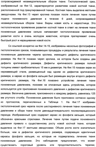 Устройство для лечения путем подкожной подачи пониженного давления с использованием текучей магистрали и связанный с ним способ (патент 2405459)