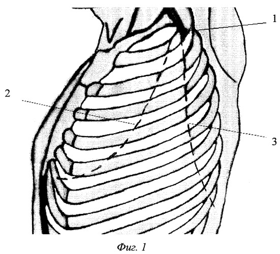 Способ выбора мини-доступа к органам грудной клетки (патент 2254070)