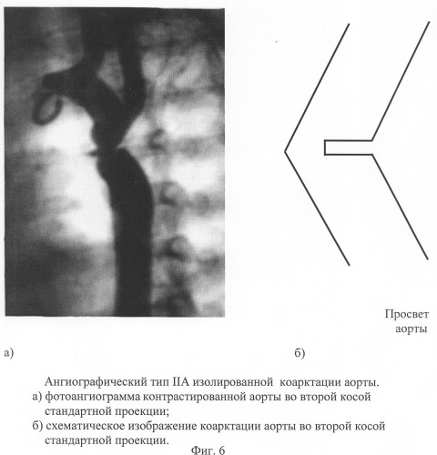 Способ диагностики изолированной коарктации аорты и способ выбора тактики ее лечения (патент 2244510)