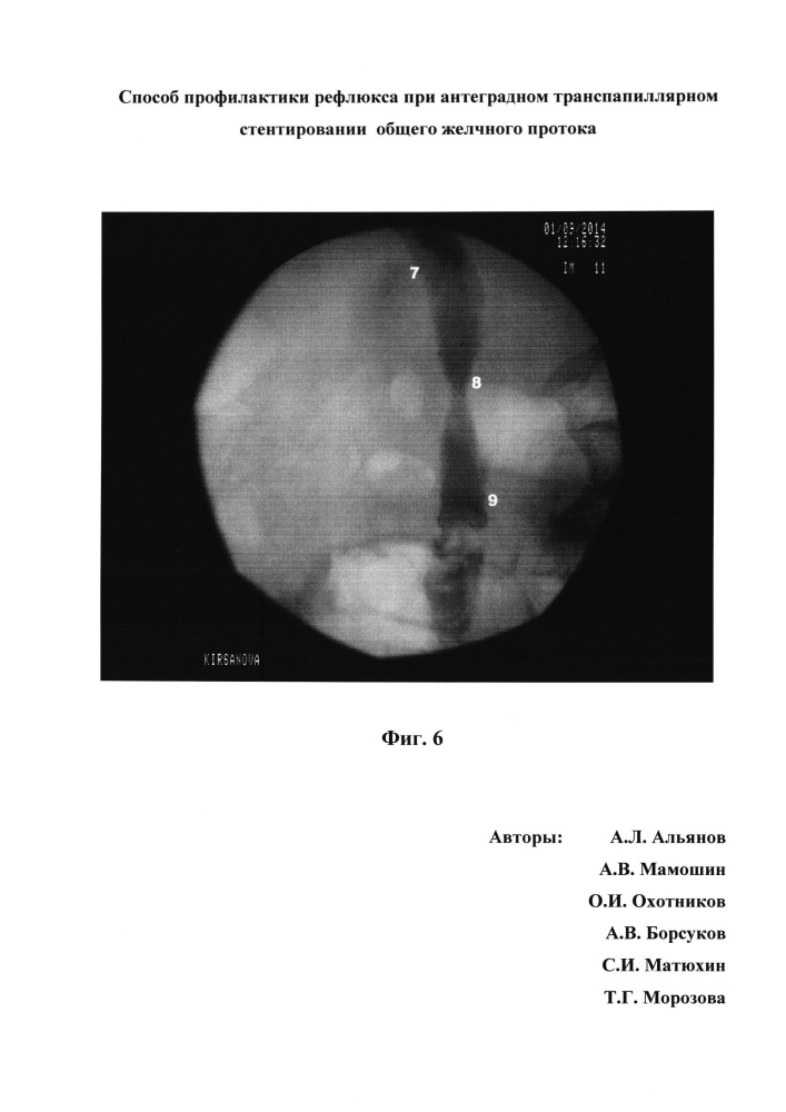 Способ профилактики рефлюкса при антеградном транспапиллярном стентировании общего желчного протока (патент 2652738)