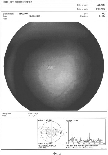 Способ оценки эффективности лечения оптического нистагма с использованием микропериметрии (патент 2535511)