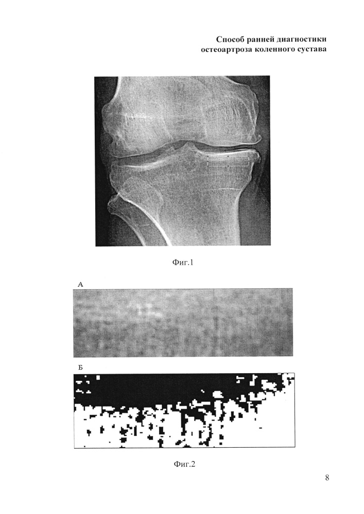 Способ ранней диагностики остеоартроза коленного сустава (патент 2644542)