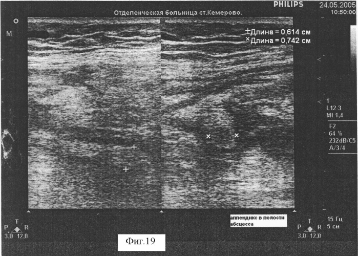Способ диагностики воспалительных форм острого аппендицита (патент 2318442)