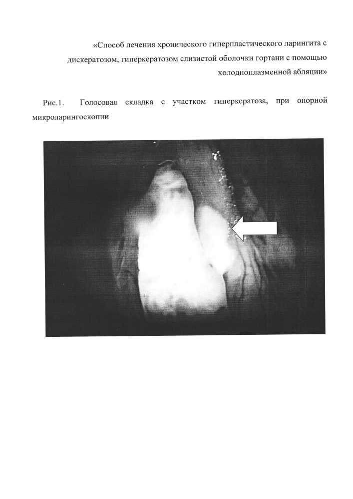 Способ лечения хронического гиперпластического ларингита с дискератозом, гиперкератозом слизистой оболочки гортани с помощью холодноплазменной абляции (патент 2658479)