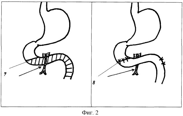Способы хирургического лечения хронической дуоденальной непроходимости (варианты) (патент 2264179)