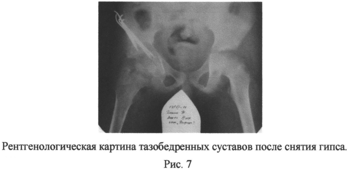 Способ выполнения периацетабулярной тройной остеотомии таза у подростков (патент 2556788)