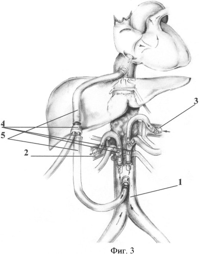 Способ временного шунтирования магистрального кровообращения при обширной резекции нижней полой вены и ее висцеральных ветвей (патент 2329773)