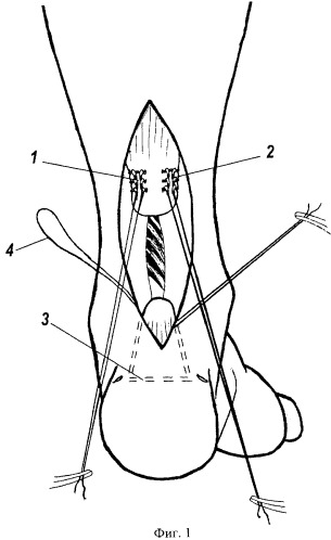 Способ оперативного лечения застарелых разрывов ахиллова сухожилия (патент 2289345)