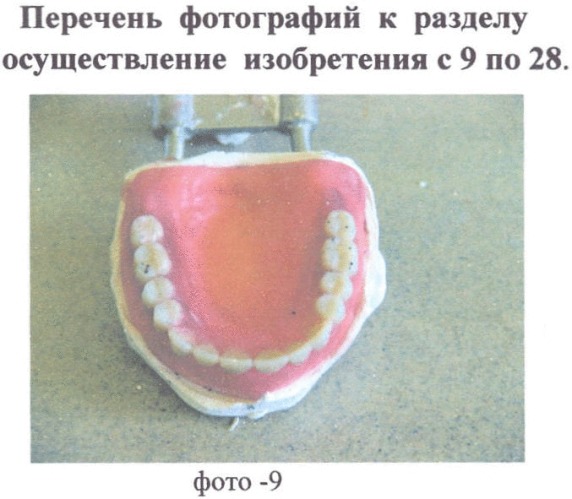Комбинированный съемный протез. метод (техника) изготовления цельнолитого металлического каркаса для комбинированного съемного протеза (патент 2382618)