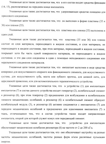 Имплантаты для создания соединений с тканями, в частности со скелетом, а также устройство и способ имплантации (патент 2314768)