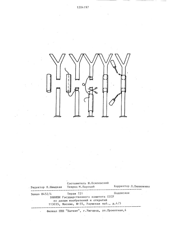 Способ восстановления нервного ствола (патент 1204197)