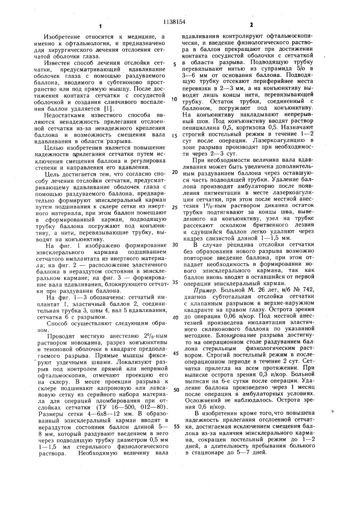 Способ лечения отслойки сетчатки (патент 1138154)