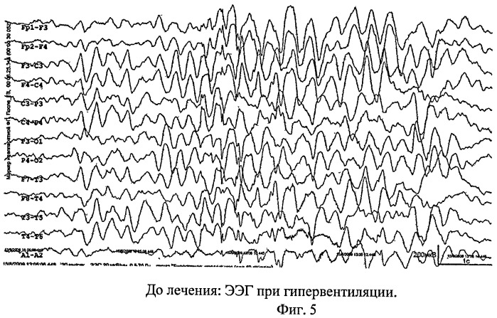 Способ лечения гиперкинетического расстройства у детей (патент 2476250)