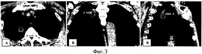 Способ оценки внутренней структуры шаровидных образований легких (патент 2515508)