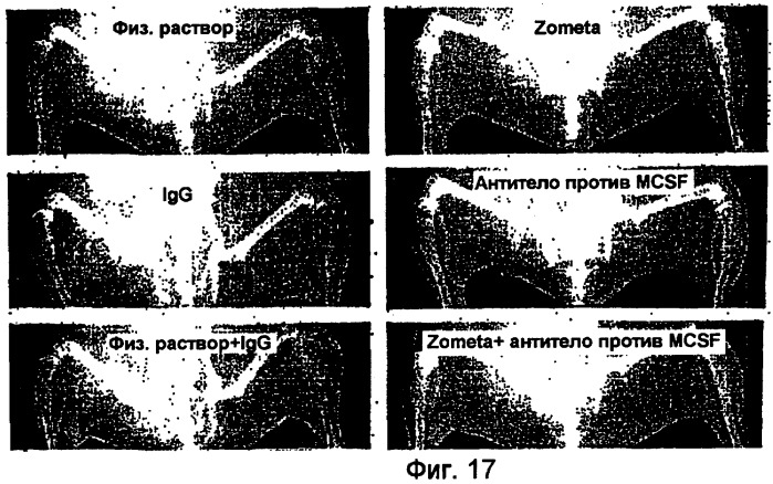 Способы профилактики и лечения ракового метастаза и разрежения кости, связанного с раковым метастазом (патент 2470665)