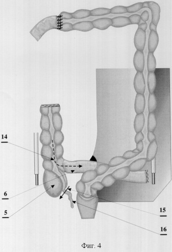 Способ илеоцекоцистопластики (патент 2323688)