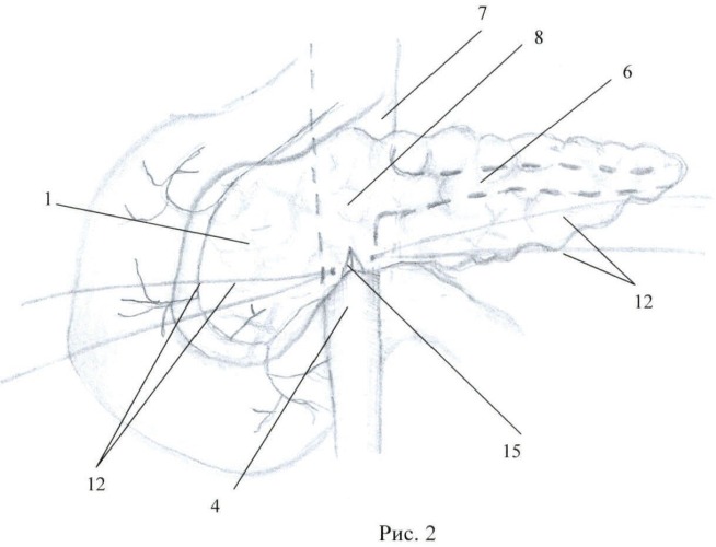Способ поперечного пересечения поджелудочной железы (патент 2476162)