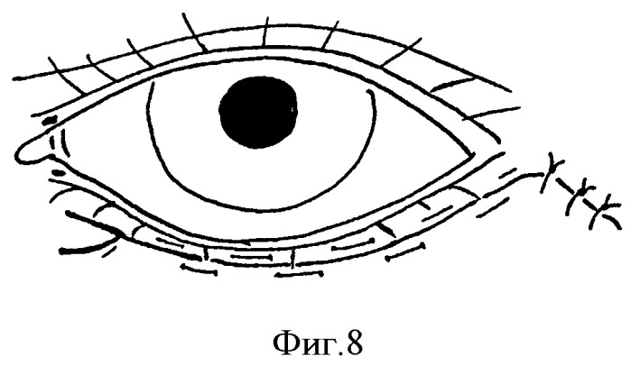 Способ устранения сенильного выворота нижнего века (патент 2380067)