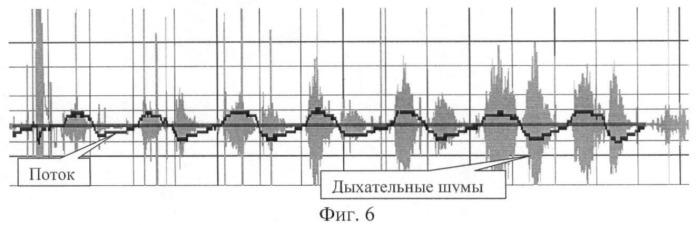 Способ фильтрации дыхательных шумов на основе задержки дыхания (патент 2415643)