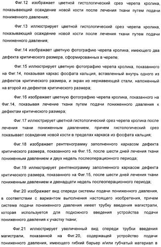 Способ лечения путем подкожной подачи пониженного давления с использованием разделения с помощью воздушного баллона (патент 2405588)