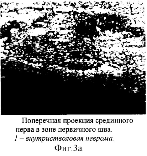 Способ ультразвуковой диагностики перерыва срединного и локтевого нервов на уровне предплечья и контроля их регенерации после шва (патент 2254808)