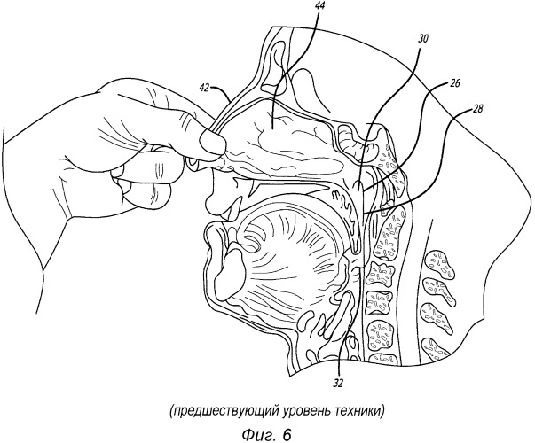 Система для лечения целевой ткани в евстахиевой трубе (патент 2559017)