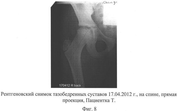 Способ лечения асептического некроза головки бедренной кости и сборы лекарственных растений для осуществления лечения (патент 2558476)