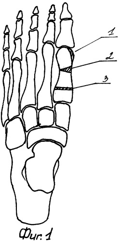 Способ хирургической реабилитации больных с &quot;hallux valgus&quot; (патент 2259174)