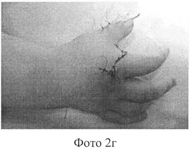 Способ реконструкции первого пальца кисти при врожденной полидактилии (патент 2577946)