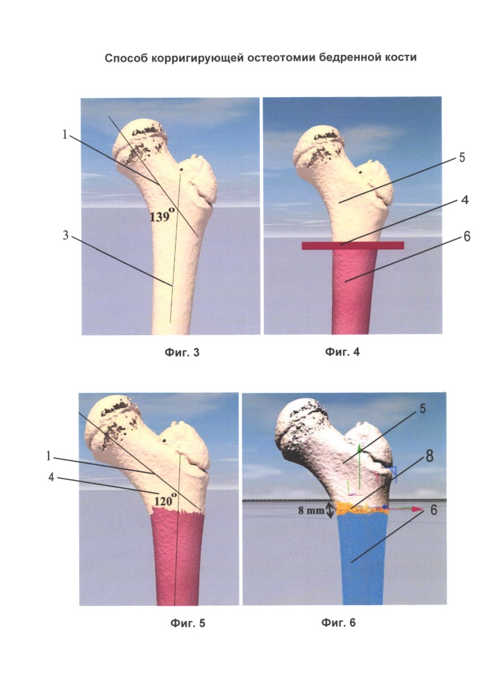 Способ корригирующей остеотомии бедренной кости (патент 2656018)