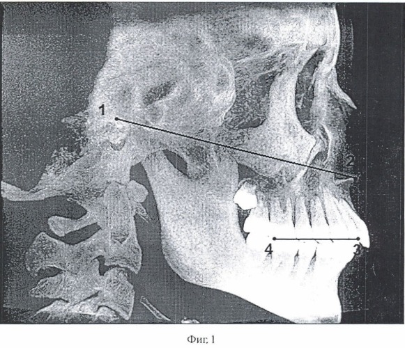 Способ нахождения анатомической плоскости, являющейся параллельной плоскости окклюзии (патент 2471452)