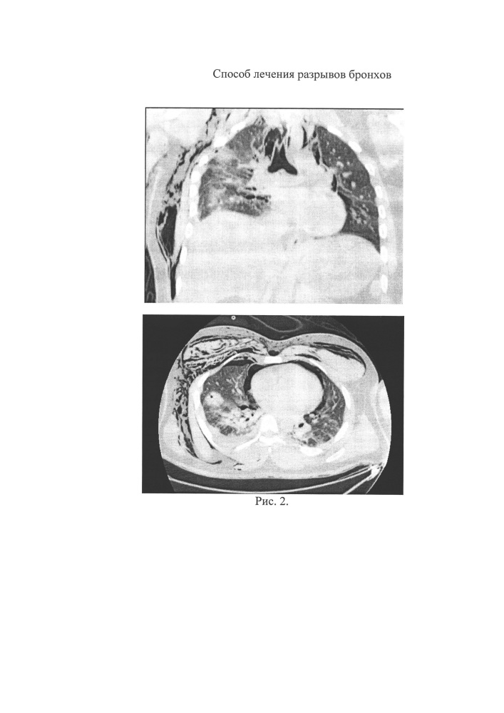 Способ лечения разрывов крупных бронхов (патент 2651691)