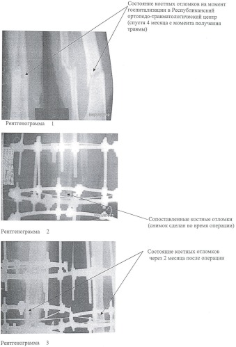 Способ лечения переломов длинных трубчатых костей при йододефицитных заболеваниях (патент 2421223)
