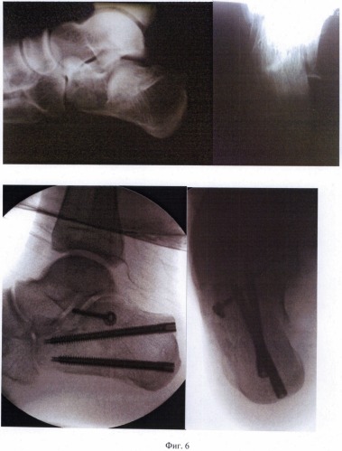 Способ лечения внутрисуставных импрессионных переломов пяточной кости (патент 2484785)