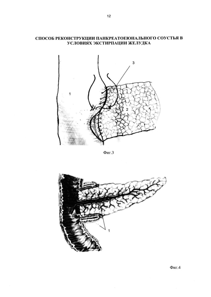 Способ реконструкции панкреатоеюнального соустья в условиях экстирпации желудка (патент 2641167)