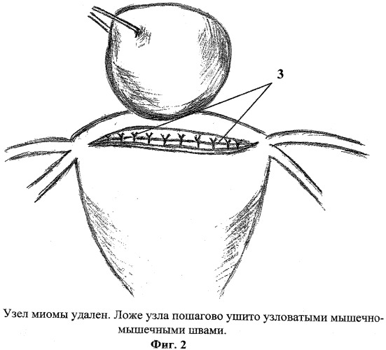 Способ удаления миомы матки (патент 2411008)