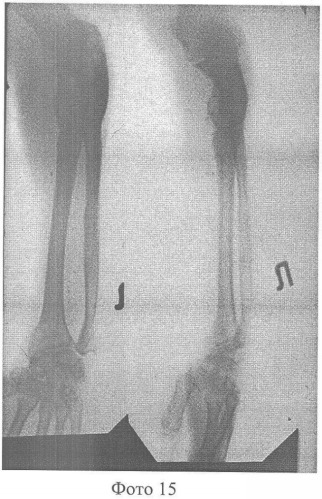 Способ хирургического лечения сегментарных дефектов диафизов костей предплечья (патент 2358677)