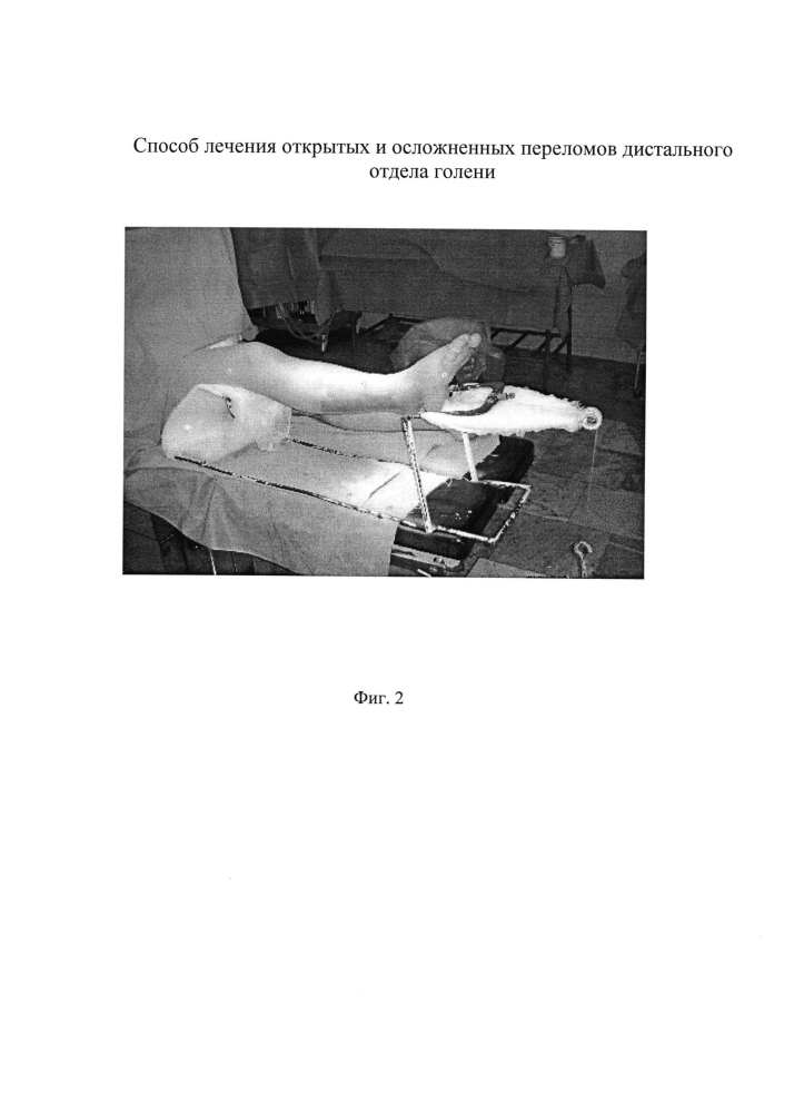 Способ лечения открытых и осложненных переломов дистального отдела голени (патент 2605647)