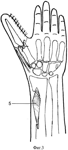Способ профилактики перелома лучевой кости при пластике "китайским" лоскутом (патент 2506053)
