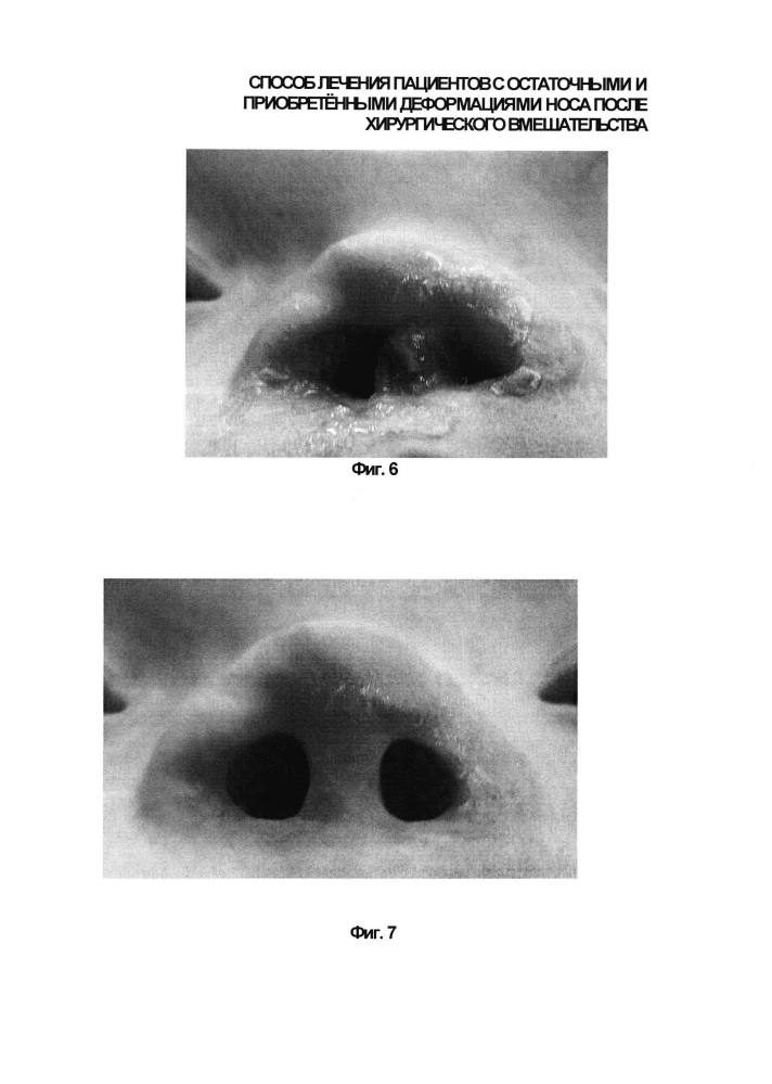 Способ лечения пациентов после хирургического вмешательства, выполненного по поводу остаточных и приобретённых деформаций носа (патент 2630130)