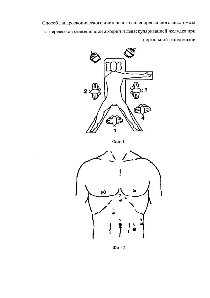 Способ лапароскопического дистального спленоренального анастомоза с перевязкой селезеночной артерии и деваскуляризацией желудка при портальной гипертензии (патент 2624812)