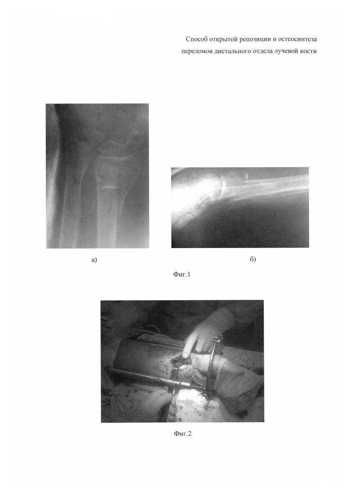 Способ открытой репозиции и остеосинтеза переломов дистального отдела лучевой кости (патент 2601850)