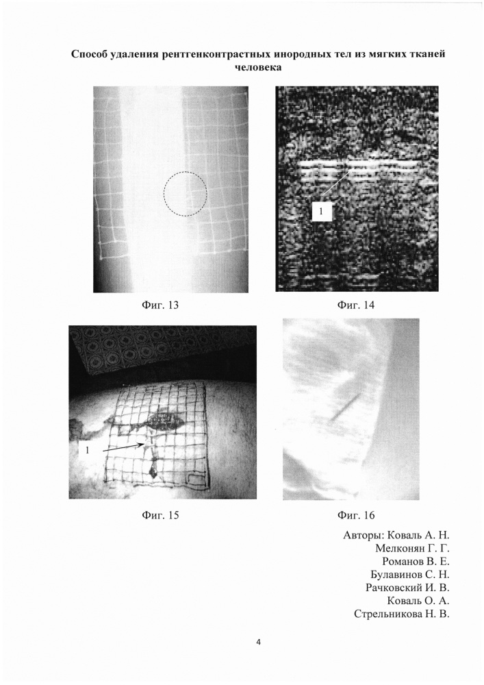 Способ удаления рентгенконтрастных инородных тел из мягких тканей человека (патент 2632517)