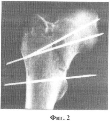 Способ диагностики степени ротационного смещения отломков проксимального отдела бедренной кости (патент 2462992)